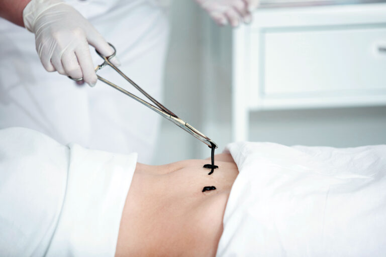 Pijawka lekarska podczas zabiegu hirudoterapii na brzuchu pacjenta