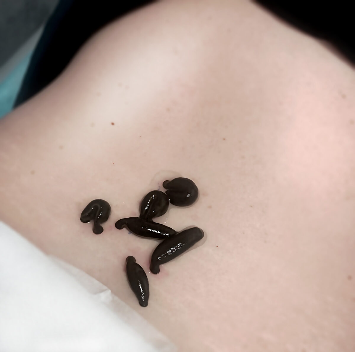 Pijawki medyczna na plecach pacjenta - zabieg hirudoterapii prowadzony w przychodni Biomed